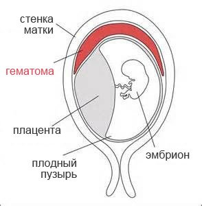 Гематома в матке