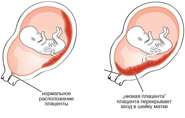 Какие Месячные При Беременности Фото