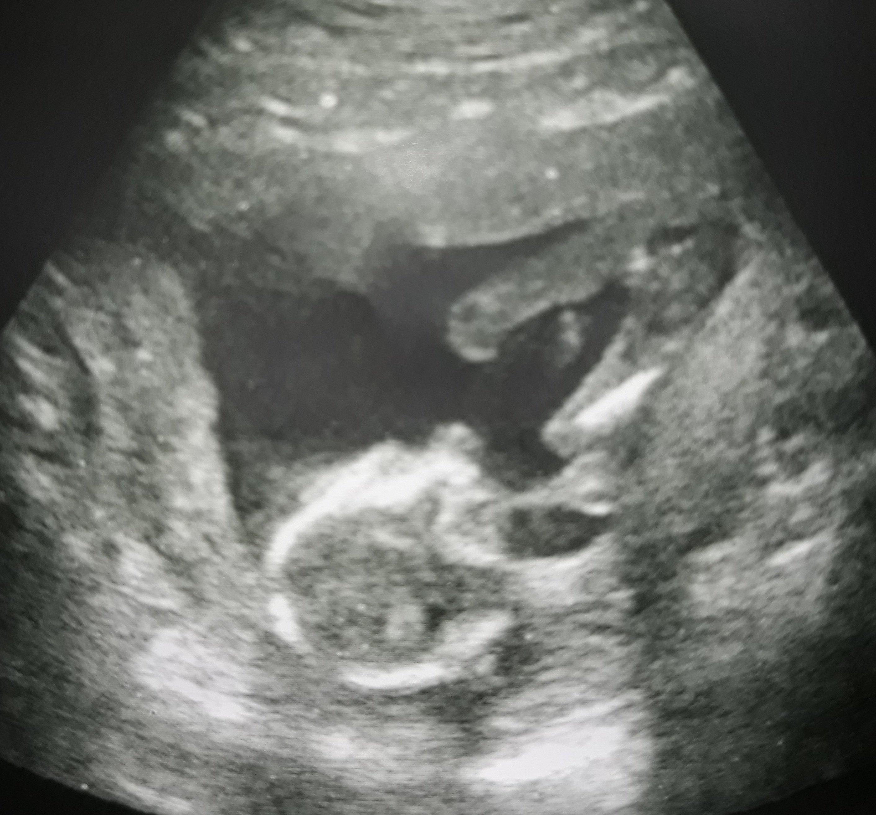 17 недель мальчик. УЗИ плода в 16 недель беременности пол. УЗИ на 16-17 неделе беременности пол. УЗИ плод девочка 12 недель беременности. УЗИ 16 недель беременности мальчик.