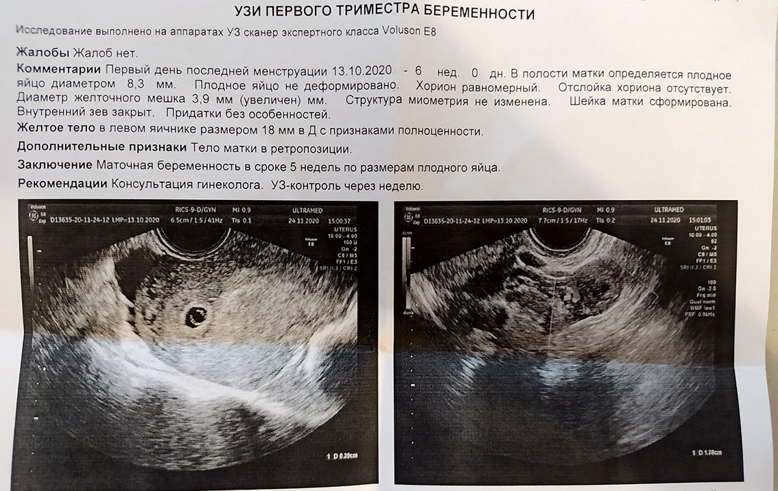 6 недель в россии. УЗИ плодное яйцо 6 недель. УЗИ беременности 6-7 недель плодное яйцо. Плодное яйцо при беременности 5 6 недель. Плодное яйцо на УЗИ 3,3мм по неделям.