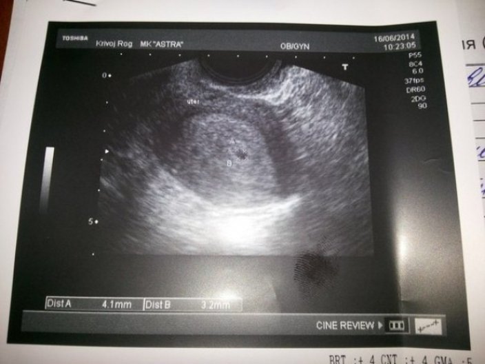 Беременность 4 недели видна на узи. УЗИ 4 недели беременности. 4 Эмбриональная неделя УЗИ. УЗИ на 4 акушерской неделе беременности. УЗИ плода 4 недели беременности.