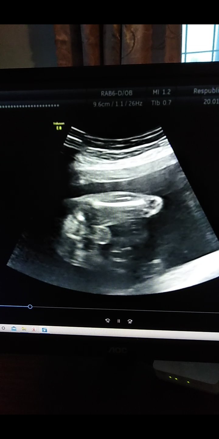 Беременность 16 Недель Мальчик Фото