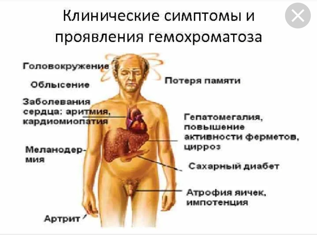 Какого цвета железы. Гемохроматоз клинические симптомы. Наследственный гемохроматоз патогенез. Основной клинический признак первичного гемохроматоза:. Гемохроматоз печени патогенез.